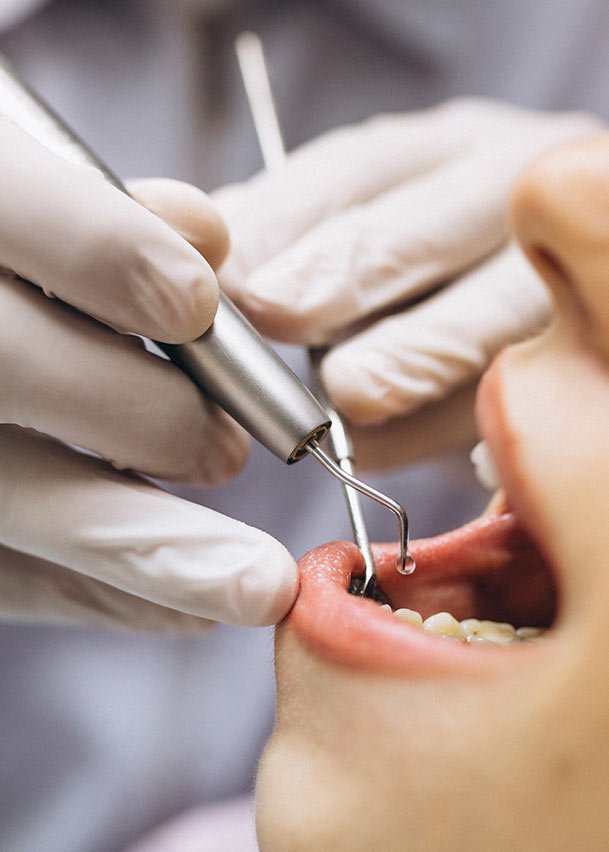 Endodoncia Sin Dolor en Bogotá (Tratamiento de Conductos)