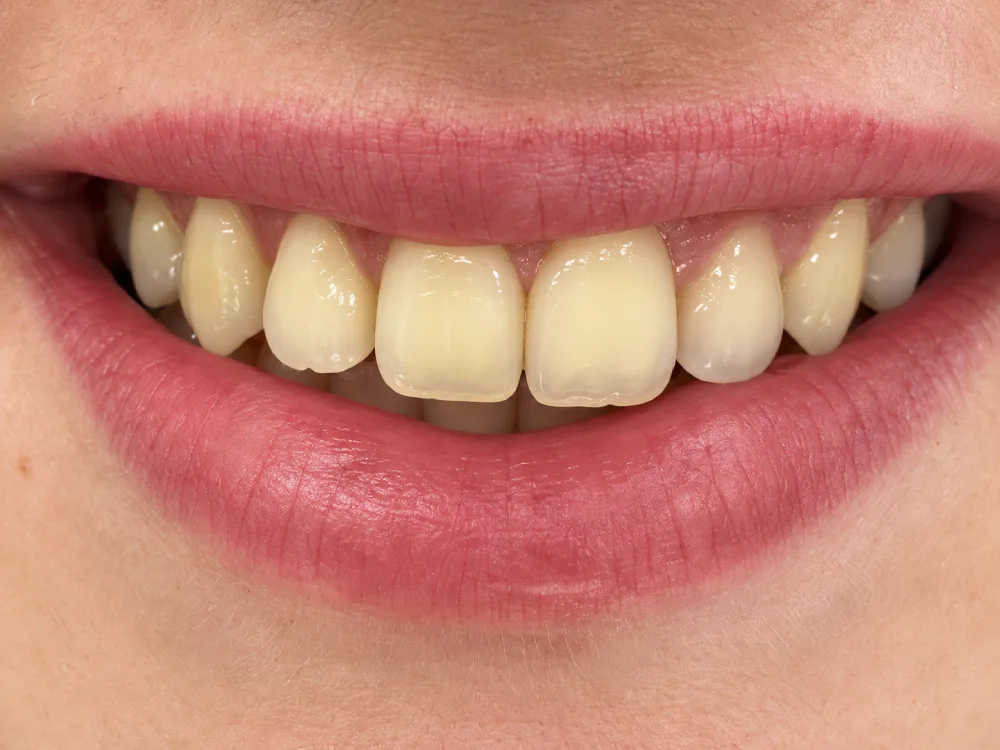 Aclaramiento Dental en Consultorio Antes