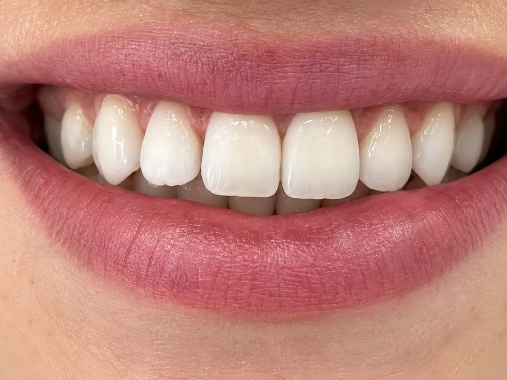 Aclaramiento Dental en Consultorio Después