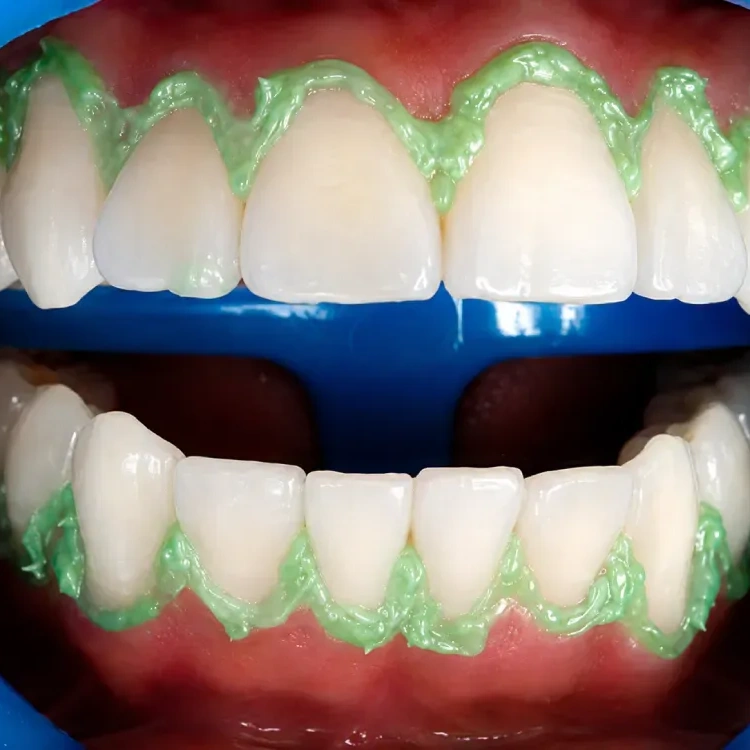 Blanqueamiento Dental