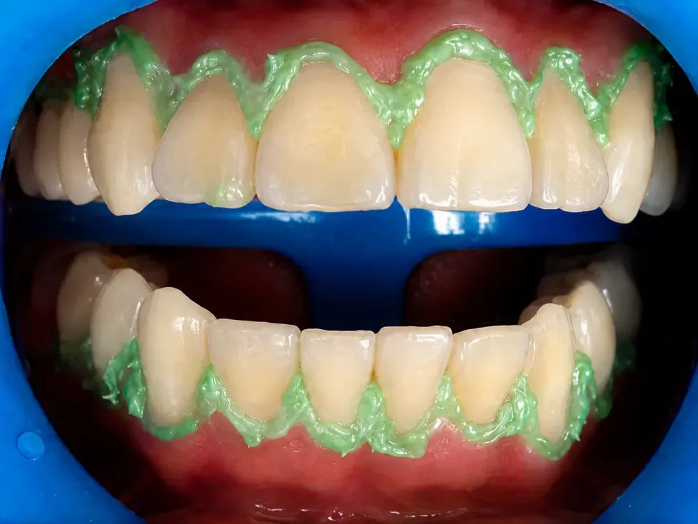 Blanqueamiento Dental Láser Antes