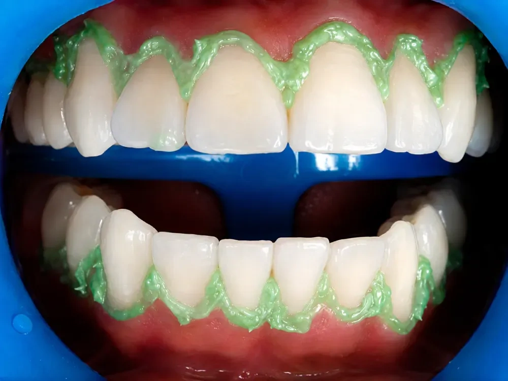 Blanqueamiento Dental Láser Después