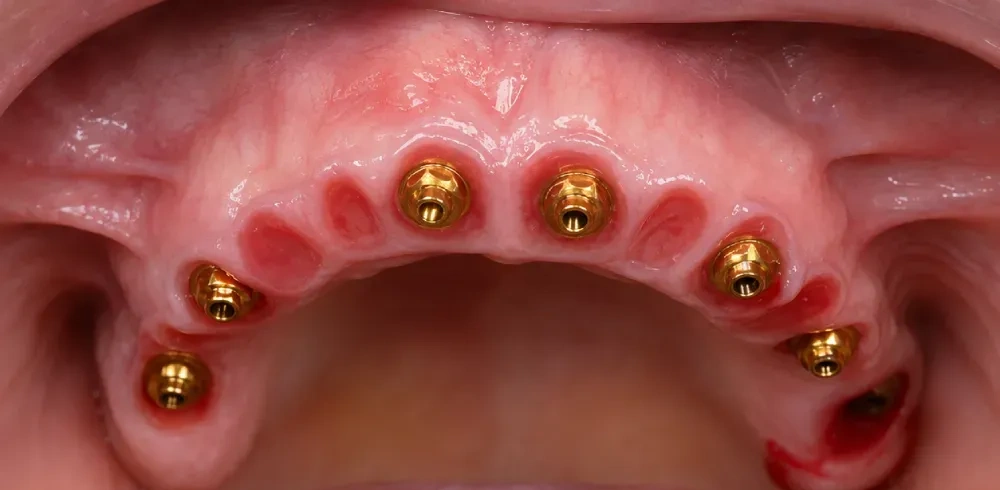 Rehabilitación Total All-on-6 / Implantes Antes