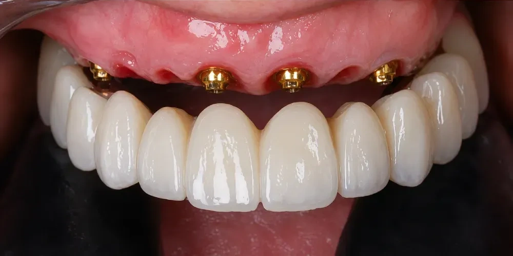 Rehabilitación Total All-on-6 / Implantes Después