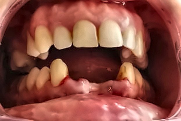 Microestética Dental y Nivelación Antes