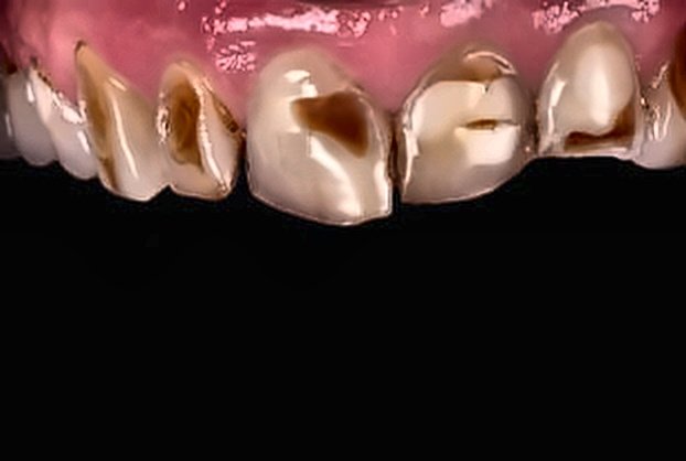 Armonización Gingival y Carillas Antes
