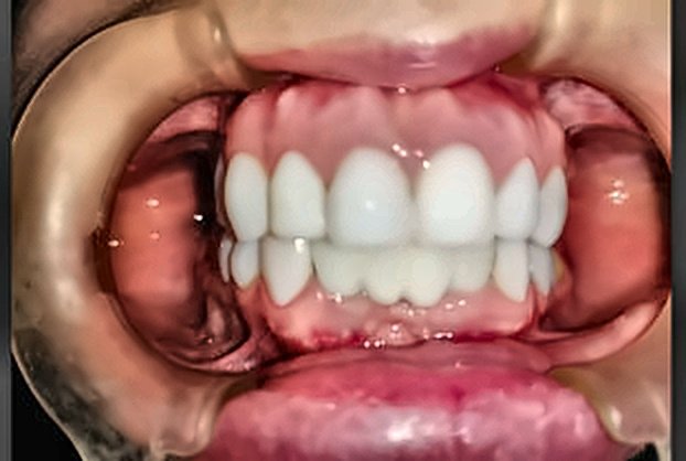 Microestética Dental y Nivelación Después