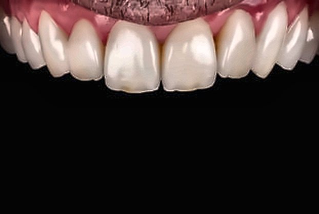 Armonización Gingival y Carillas Después