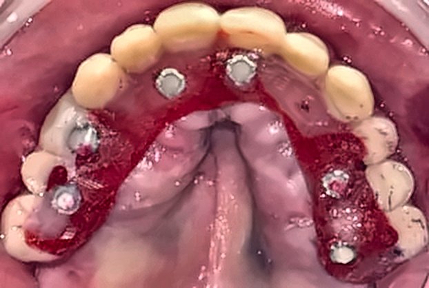 Rehabilitación Fija sobre Implantes Múltiples Antes