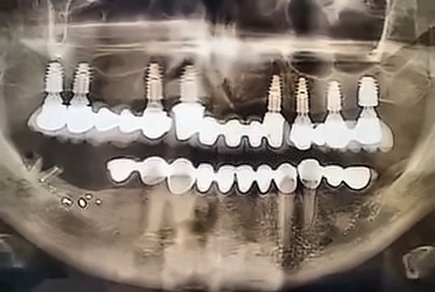 Rehabilitación con Implantes Múltiples Antes