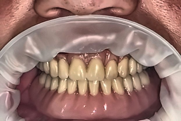 Rehabilitación Fija sobre Implantes Múltiples Después
