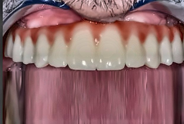 Rehabilitación con Implantes Múltiples Después