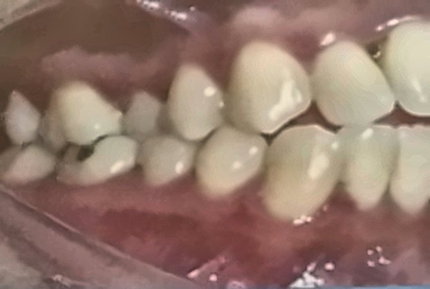 Caso Clínico: Ortodoncia y Alineación Dental Antes
