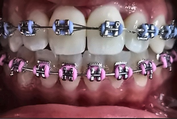 Caso Clínico: Ortodoncia y Alineación Dental Después