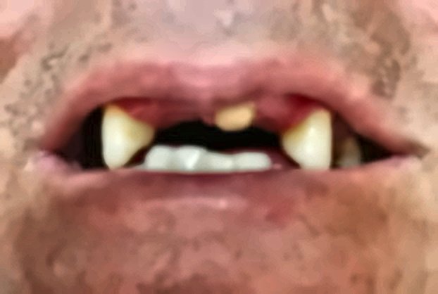 Caso Clínico: Prótesis Dental de Precisión Antes