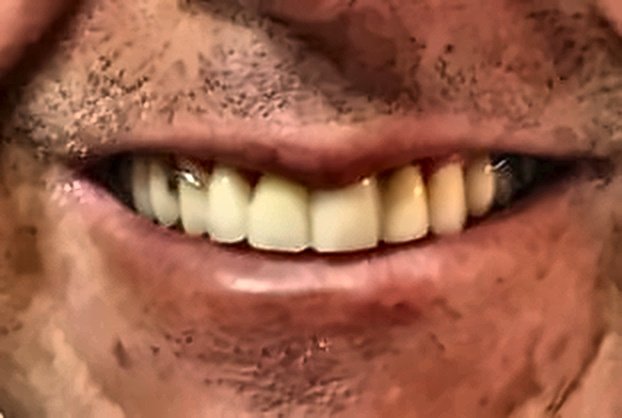 Caso Clínico: Prótesis Dental de Precisión Después